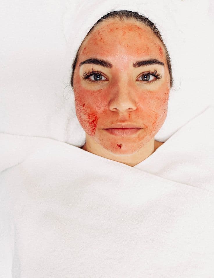 Vampire Facial / PRP