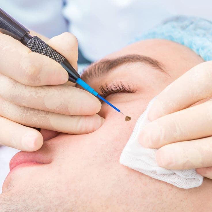 Skin Tag & Mole Removal